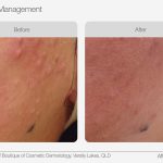 IPL_Acne_Management_Before_After_01