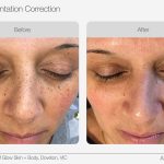 IPL_Pigmentation_Correction_Before_After_01-min