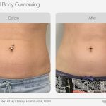 Ultrasound_Body_Contouring_Before_After_07-min