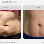 Ultrasound_Body_Contouring_Before_After_08-min