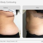 Ultrasound_Body_Contouring_Before_After_13-min