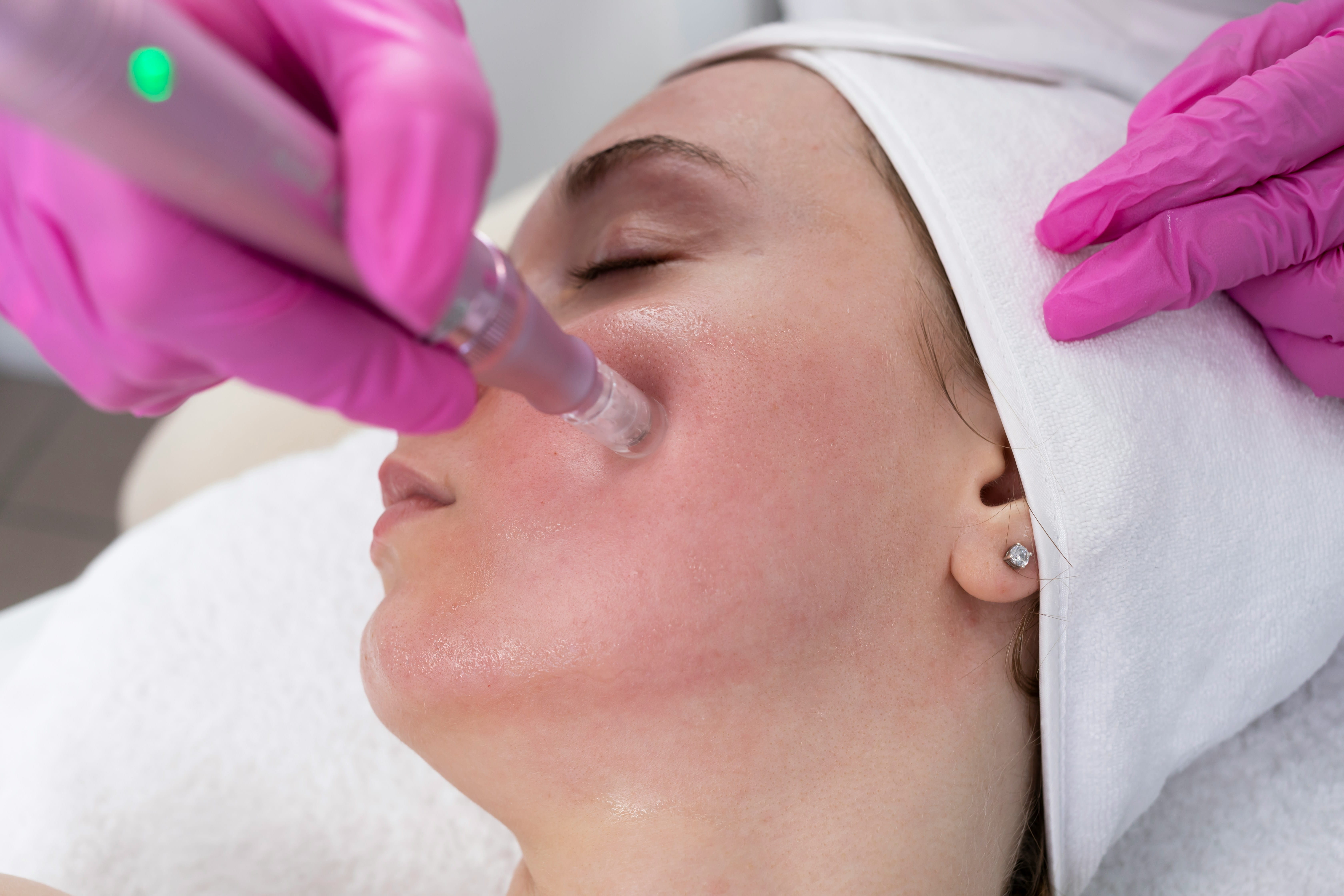 A person receives a facial treatment with a microneedling device while lying down, attended by someone wearing pink gloves.